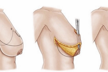 O que considerar antes de uma mamoplastia redutora
